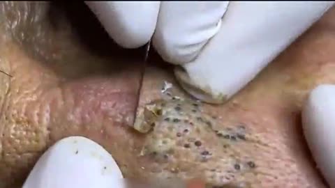 Removal Of Blackheads On The Nose