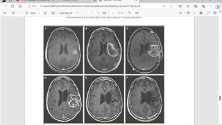 Graveyard Shift Ep47 (Treatment for Glioblastoma with PVSRIPO) by Dr. Paul Cottrell