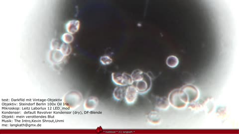 microscope darkfield-test my rottin' blood , Acanthocytes (spur cells)