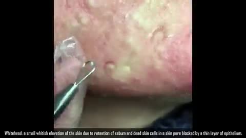 Blackhead Fields! 4,000 Blackheads