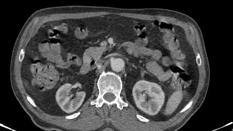 Abdominal CT angiography, axial view