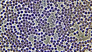 White blood cell phagocytes moving in blood, with red blood cell hemolysis.