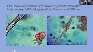 Blood Analysis- from Covid JABS- -Nano -Tech -Circuitry Dr. Anna Mihalcea - Even Unvaxxed People