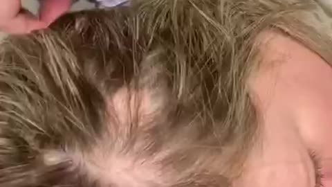 Woman losing hair because of the covid vaccine, as shown in this video