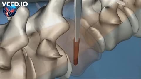 Scoliosis Treatment Surgery.[3D-Animation lateral column deviation]