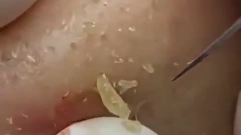 Extraction blackhead and pimple