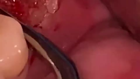 Remaining Tooth Root Extraction #shorts #dentist