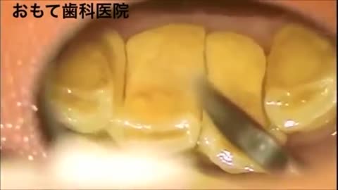 Satisfying Tartar Removal