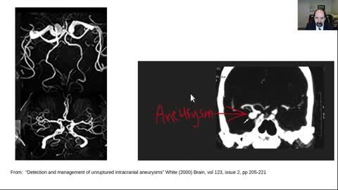 Cerebral aneurysms