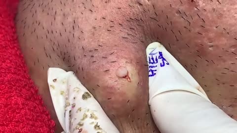Satisfying Relaxing With pomping the Master Acne
