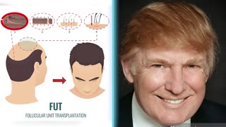 DJ'S Possible Hair Transplant ;-)