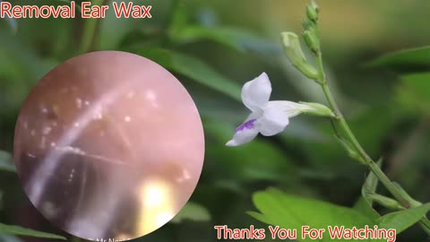 gigantic ear wax removal #9