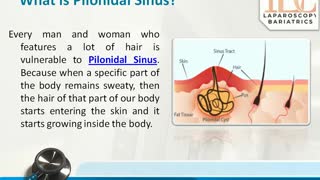 Laser Pilonidal Sinus Specialist in Indore Dr. Achal Agrawal