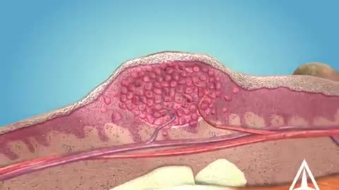 What are warts (HPV)- - 3D animation