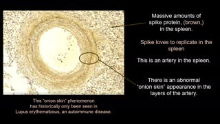 Histopathology of the Spike Protein for Laypersons