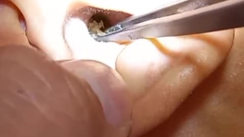 Ear wax cleaning