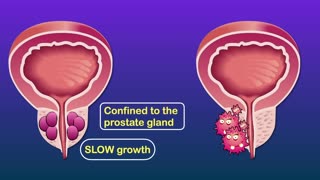 Prostate Cancer Signs | Warning Signs of Prostate Cancer