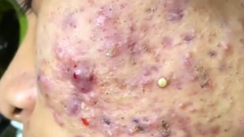 pimple popping satisfaction