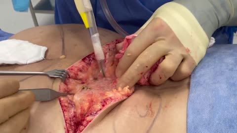 Surgical Removal of Illegal Silicone Buttock Injections | Plastic Surgery Procedure