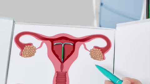 Intrauterine Contraceptive Devices: Your Guide