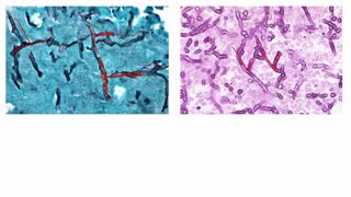 Opportunistic Fungal Infections