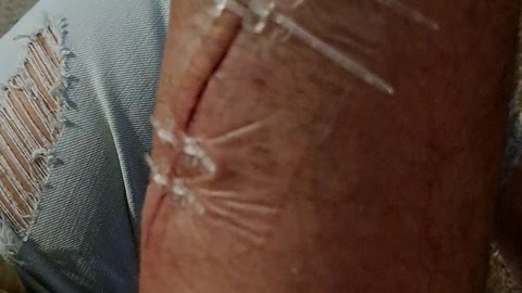 Zip stitches work amazing