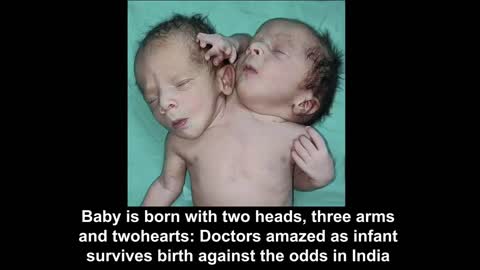 New Born Baby With Two Heads Three Arms And Two Hearts