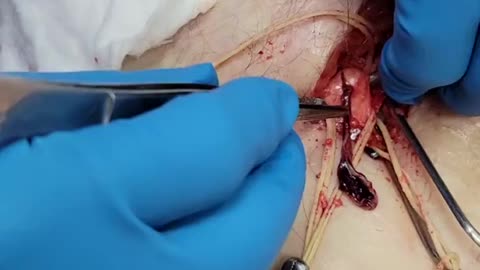 "This Is Not Normal" - Embalmer Richard Hirschman Releases Footage of Unbelievable Blood Clots