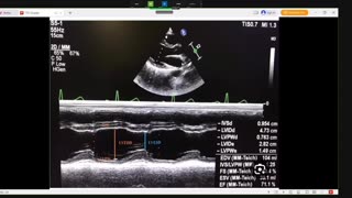 2nd lecture of basics of TTE