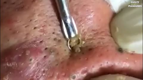 The Most Satisfying Giant Blackheads Removal