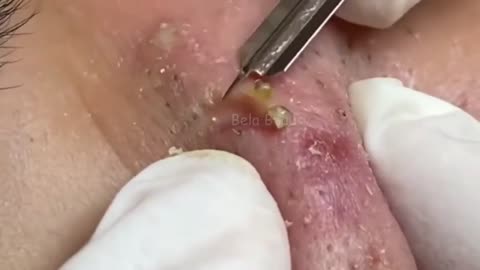 Cleaning blackheads and pimples. 3