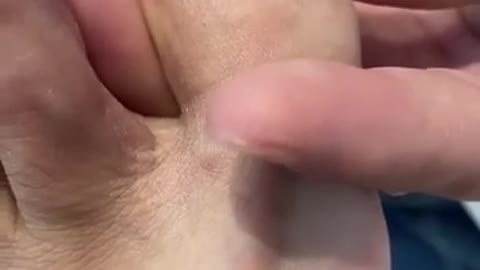 INGROWN TOENAIL REMOVAL