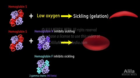 SICKLE CELL DESEASE TO ANEMIA