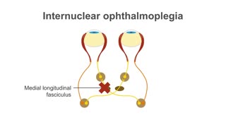 Clinical Neurology Essentials 6.Recognizing dysconjugate gaze