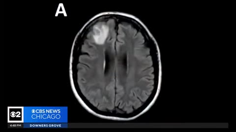 Live worm found in woman's brain