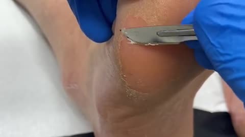 Thick forefoot callus removal by Australian podiatrist