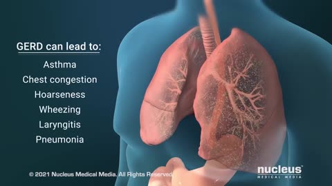 [2022-04-05] What Causes GERD?