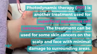 Treatments For Squamous Cell Carcinoma