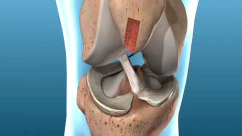 ACL Surgery Knee Ligament Surgery ACL Repair