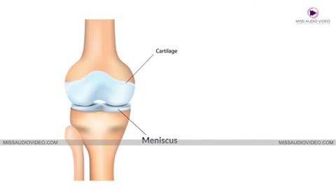 Osteoarthritis Treatment Explainer Video Animation