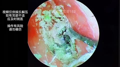 gigantic ear wax removal #22