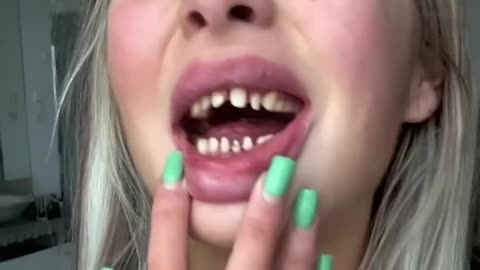 Georgia shares her experience getting veneers in Turkey 😁✨