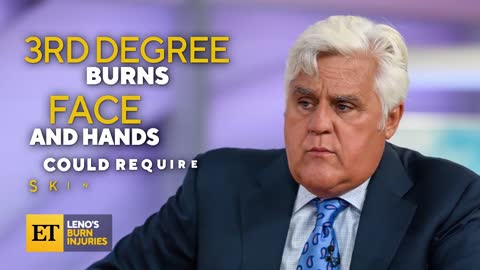 Jay Leno Shares How Fiery Accident Caused 3rd-Degree Burns
