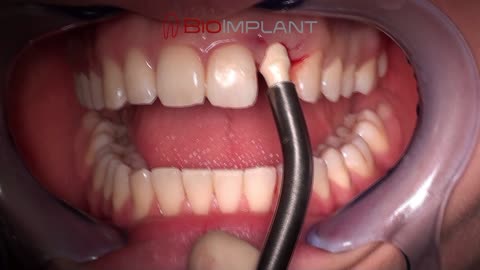 *** RAI ROOT ANALOGUE DENTAL IMPLANT PLACED IN THE ESTHETIC ZONE IN LESS THAN 1 MINUTE. ***