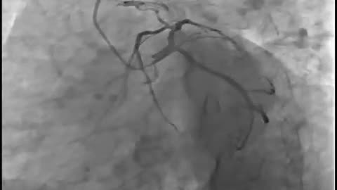 Coronary Artery - Short Infomedia Video Clip With Microphotos