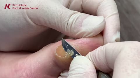 SUPER Dry & Painful Calluses Removal