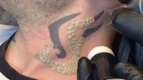 Most Amazing Tribal Tattoo Removal!