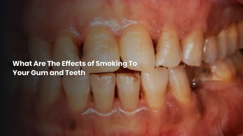 What Are The Effects of Smoking To Your Gum and Teeth