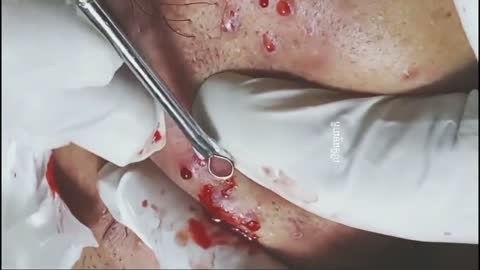 BLACKHEADS Extraction