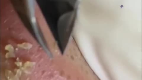 Blackhead Satisfying